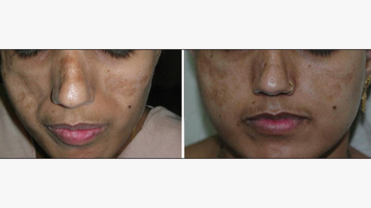 Scar Repair Cream Acne Scar Treatment Serum Removal Stretch Marks  Discoloration Surgery Burn Smooth Skin Care