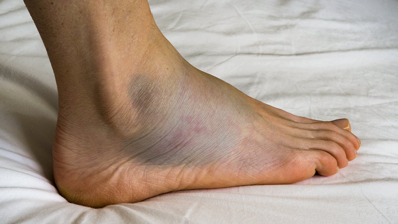 bruise-on-top-of-foot-after-rolling-ankle-clearance