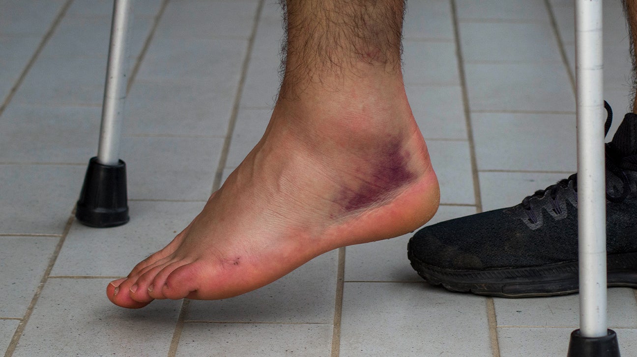 Fluid On Foot And Ankle Discount Emergencydentistry