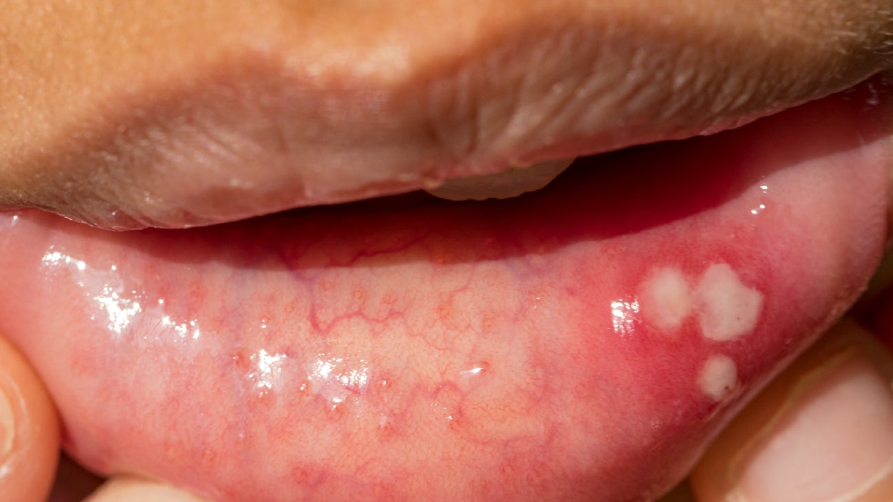 Multiple Canker Sores Under Tongue