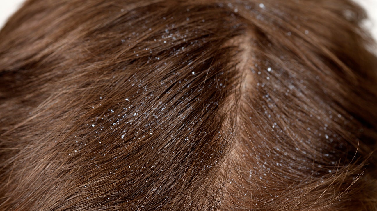 Dandruff vs Psoriasis: How to Tell the Difference