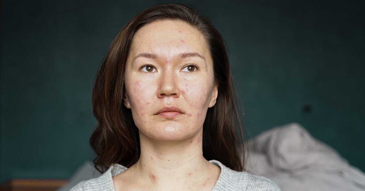 Acne in College: Causes, Treatment, and Prevention