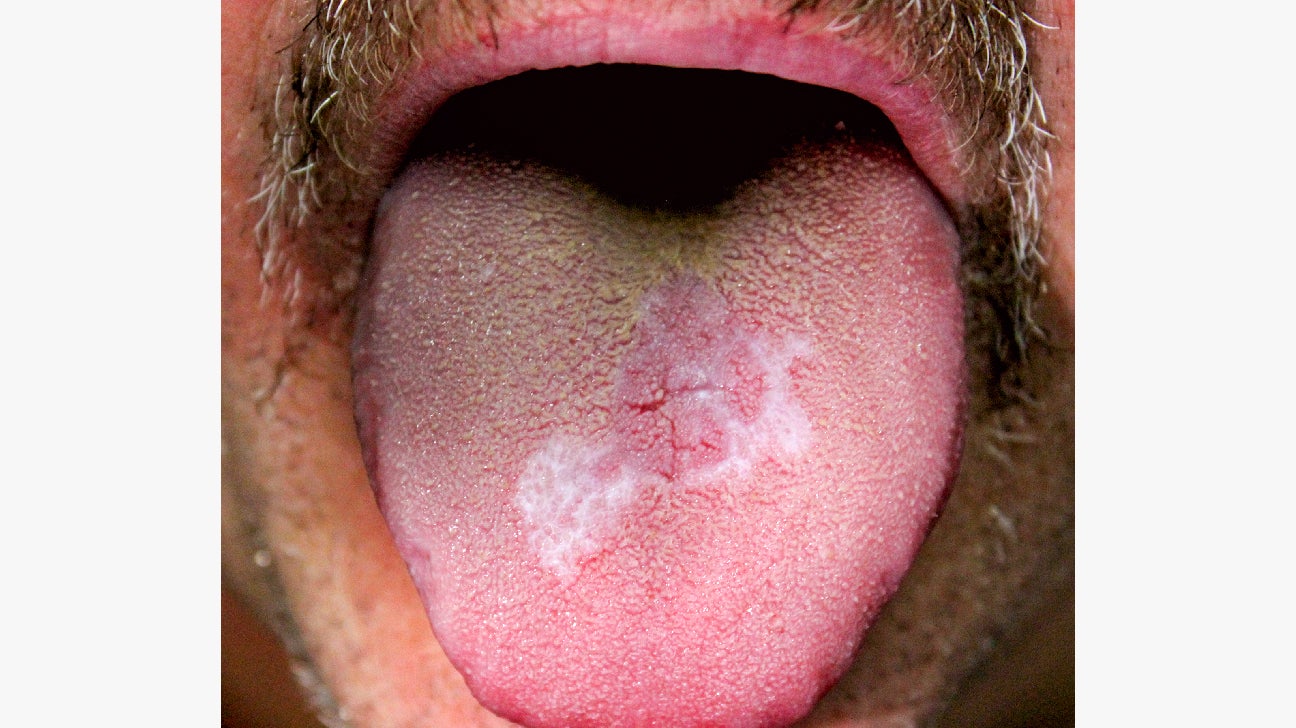 Mouth Sores Pictures, Causes, Types, Symptoms, and Treatments