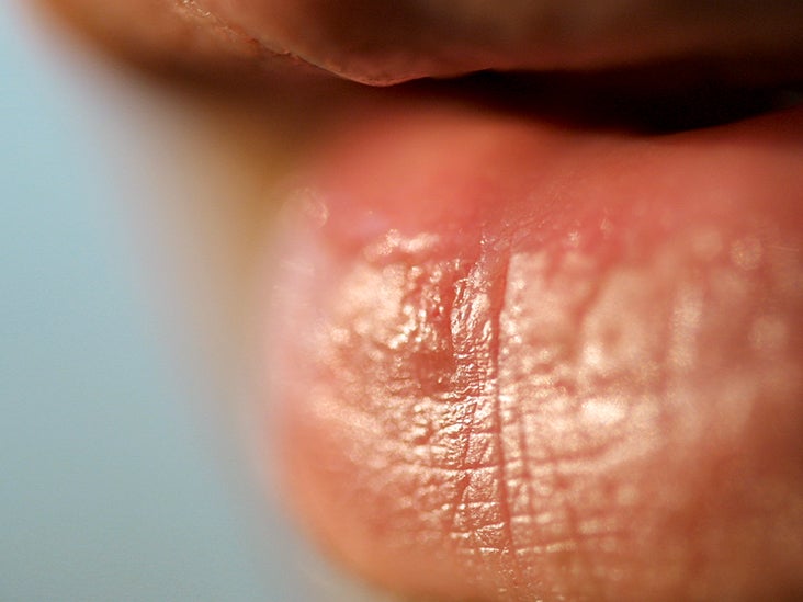 ehat causes sores ontour tongue