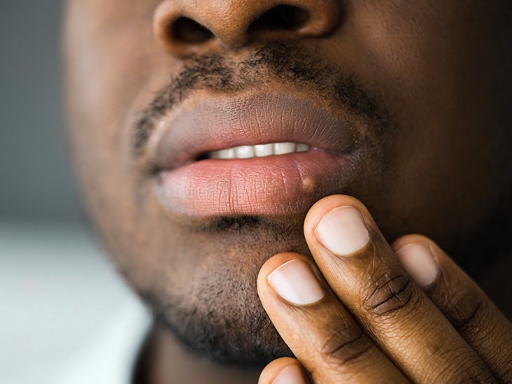 Oral STDs Symptoms, Treatment, and More photo