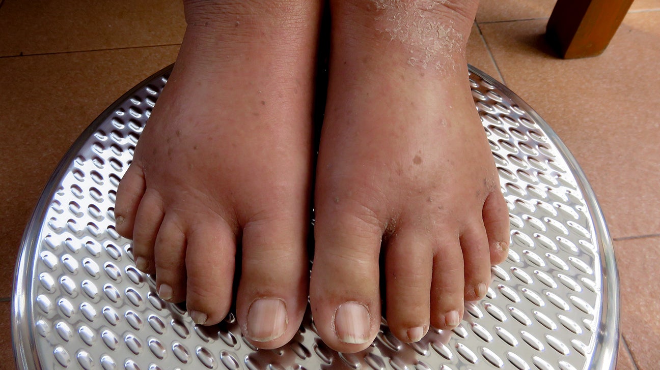 What are the reasons behind swollen feet and ankles?