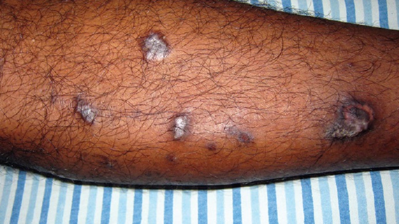 WHAT IS LICHEN PLANUS SYMPTOMS CAUSES DIAGNOSIS AND MORE Chiid Health