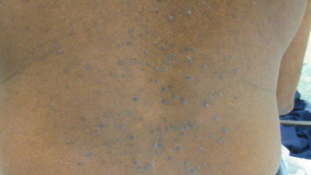 lichen striatus african american