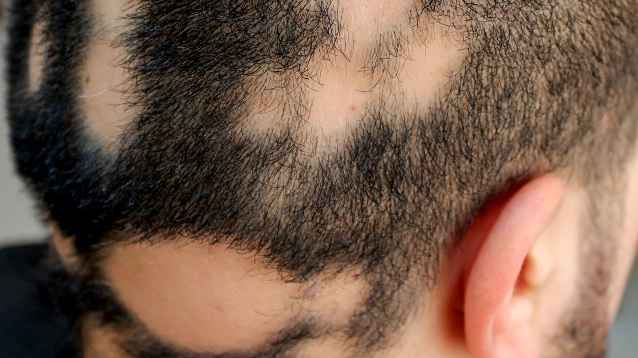 Signs and symptoms of alopecia areata