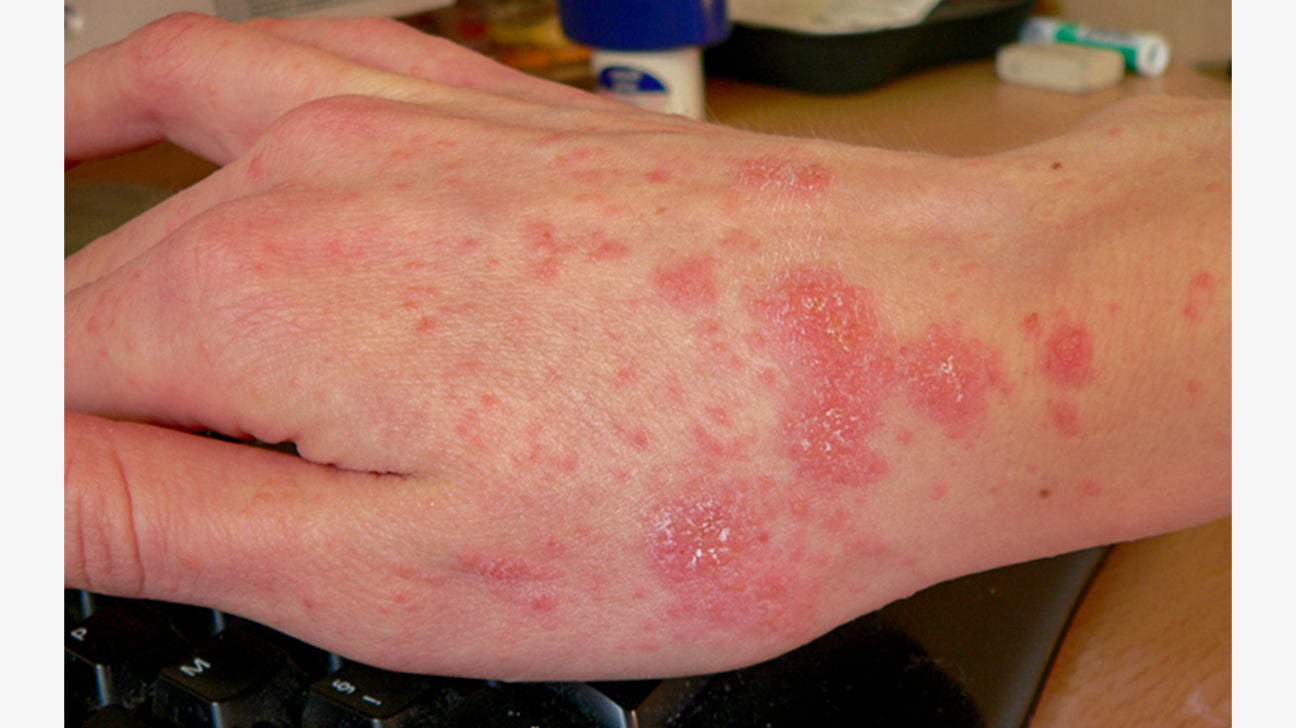 rash on skin