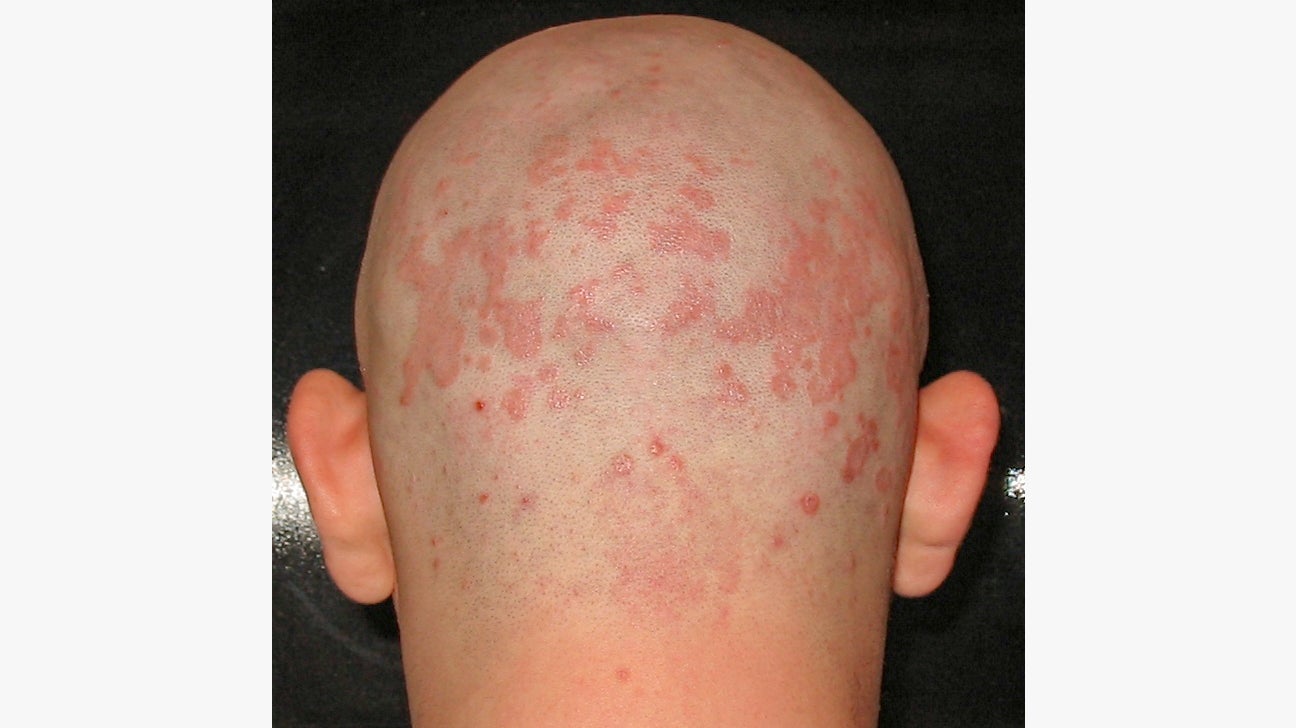 Bungalow hver dag Vent et øjeblik Seborrheic Dermatitis: On Scalp, Treatment, Crib Cap, and More