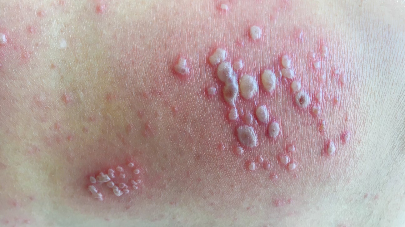 22 Common Skin Rashes Pictures Causes And Treatment