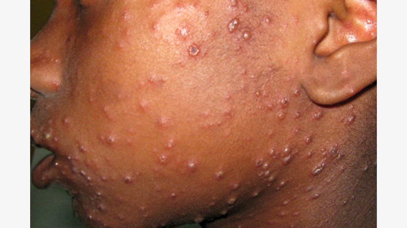 Rash and Swollen Lymph Nodes Causes, Photos, and Treatment