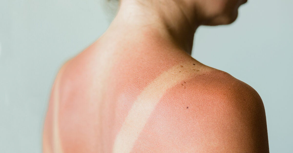 What Does It Mean If Your Sunburn Is Bumpy