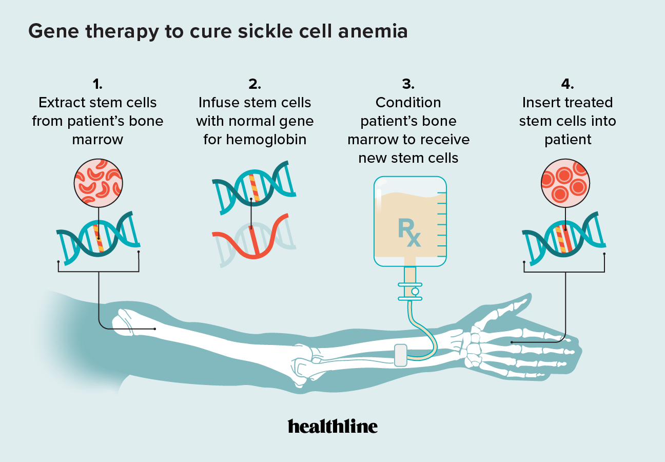 Sickle Cell Anemia And Gene Therapy How It Works