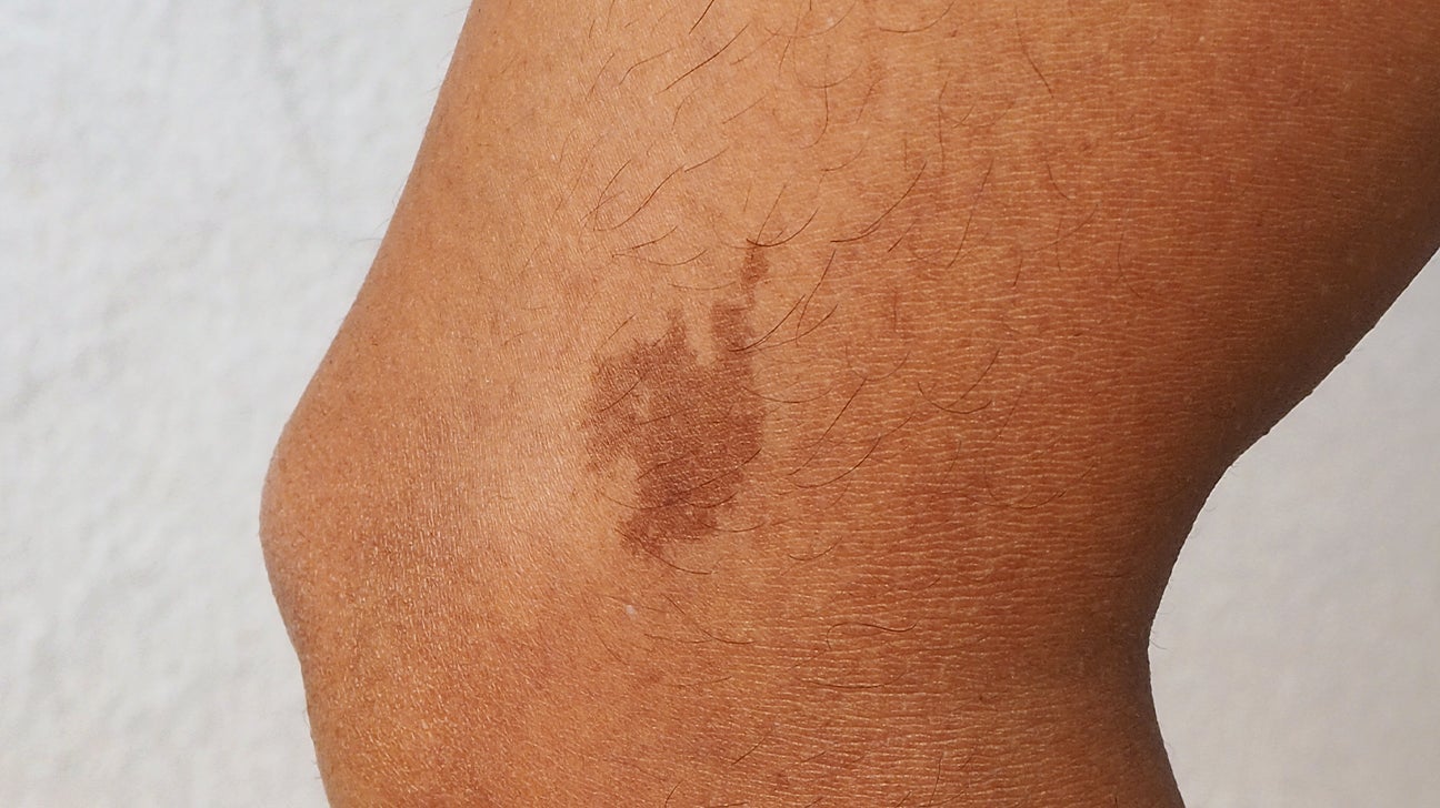 Dark patches outlet on skin