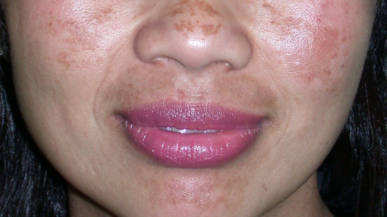 Skin Discoloration Causes Pictures And Treatment