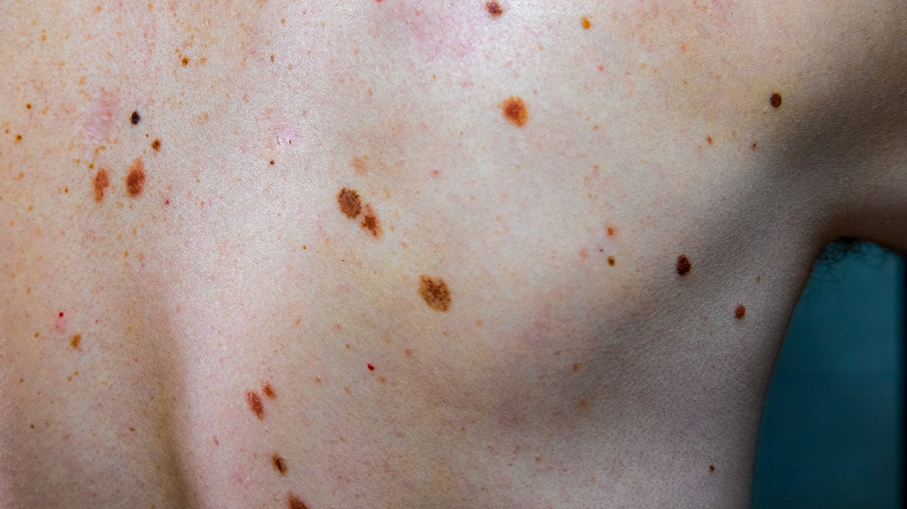 Skin Discoloration: Causes, Pictures, and Treatment
