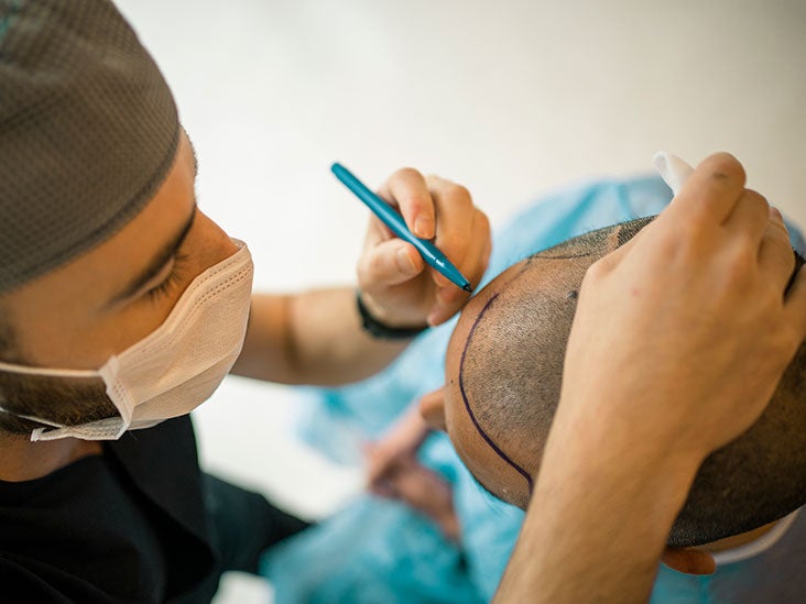 Hair Transplant: Procedure, Recovery, Complications, and More