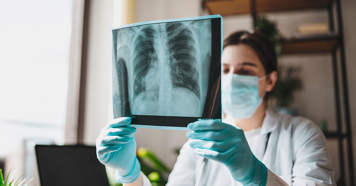 Can X-Rays Detect Non-Small Cell Lung Cancer?