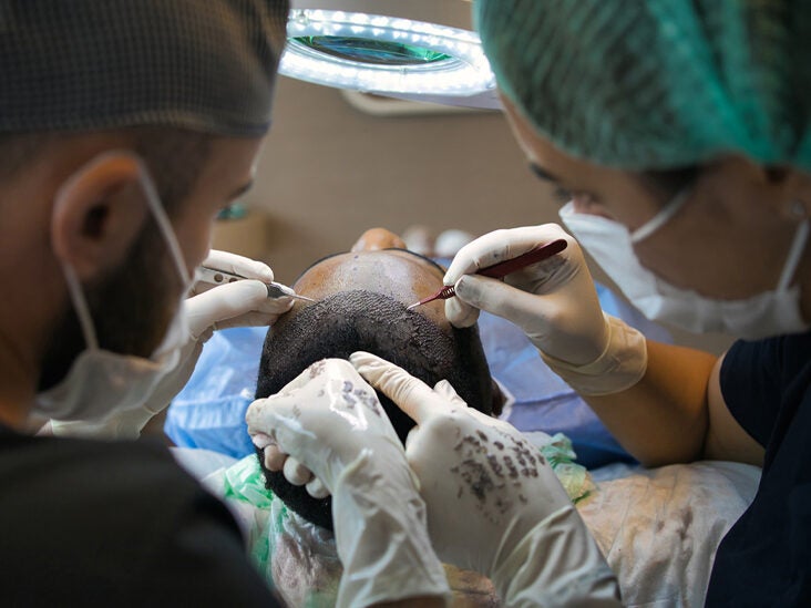 DHI Hair Transplant Procedure: Benefits, Side Effects, How It Works