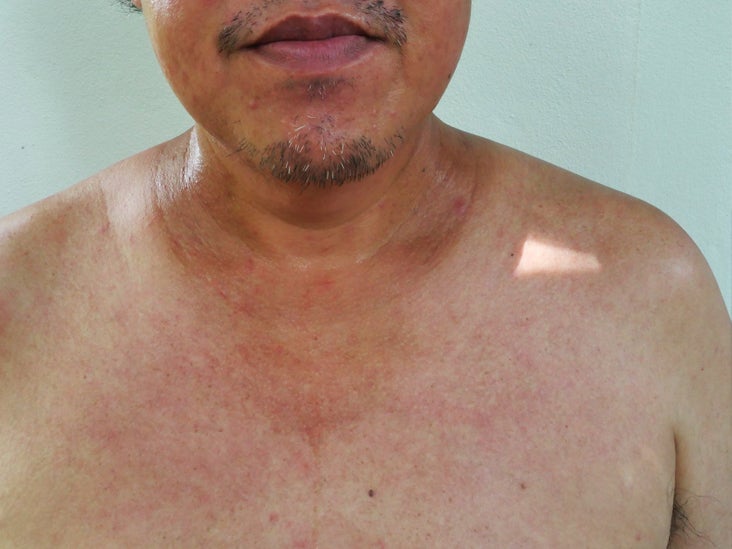 small-cell-lung-cancer-with-hyperpigmentation