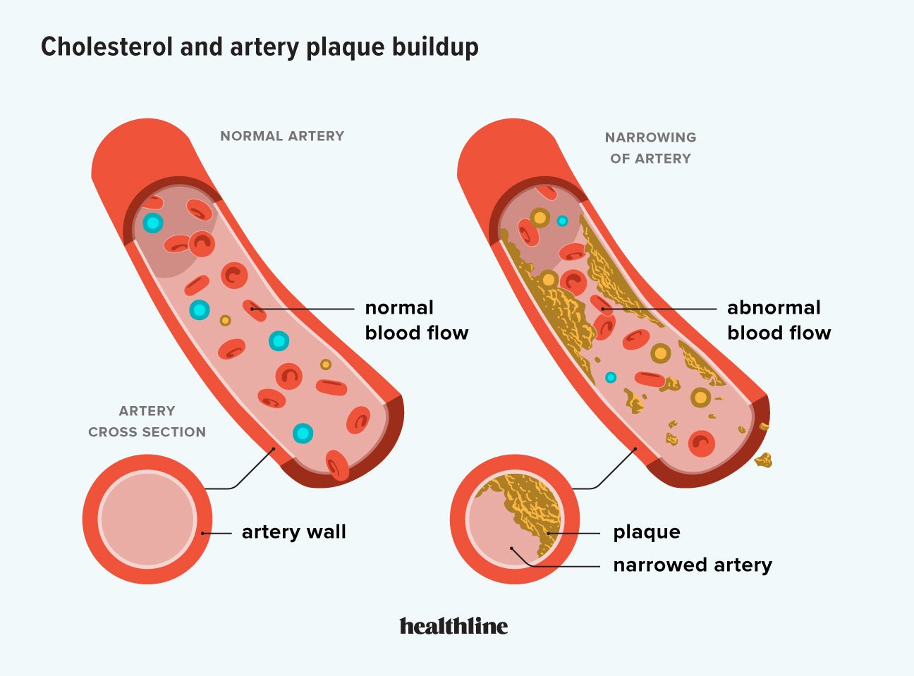 The Role Cholesterol Plays In Artery Plaque Buildup