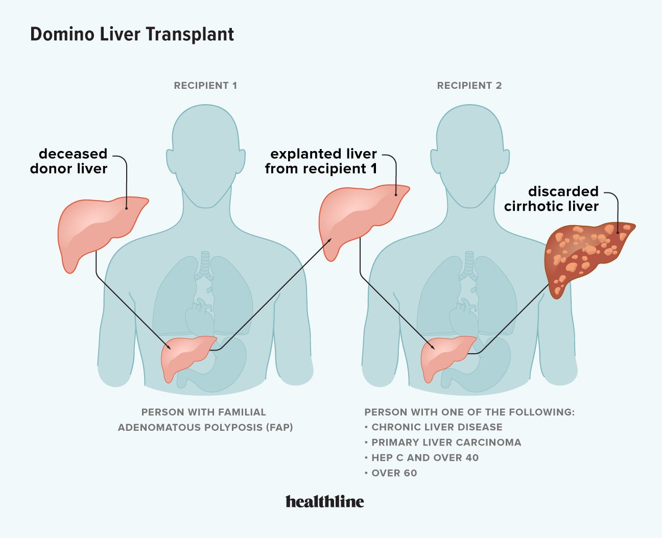 Apa Itu Transplantasi Hati Domino? – Keren