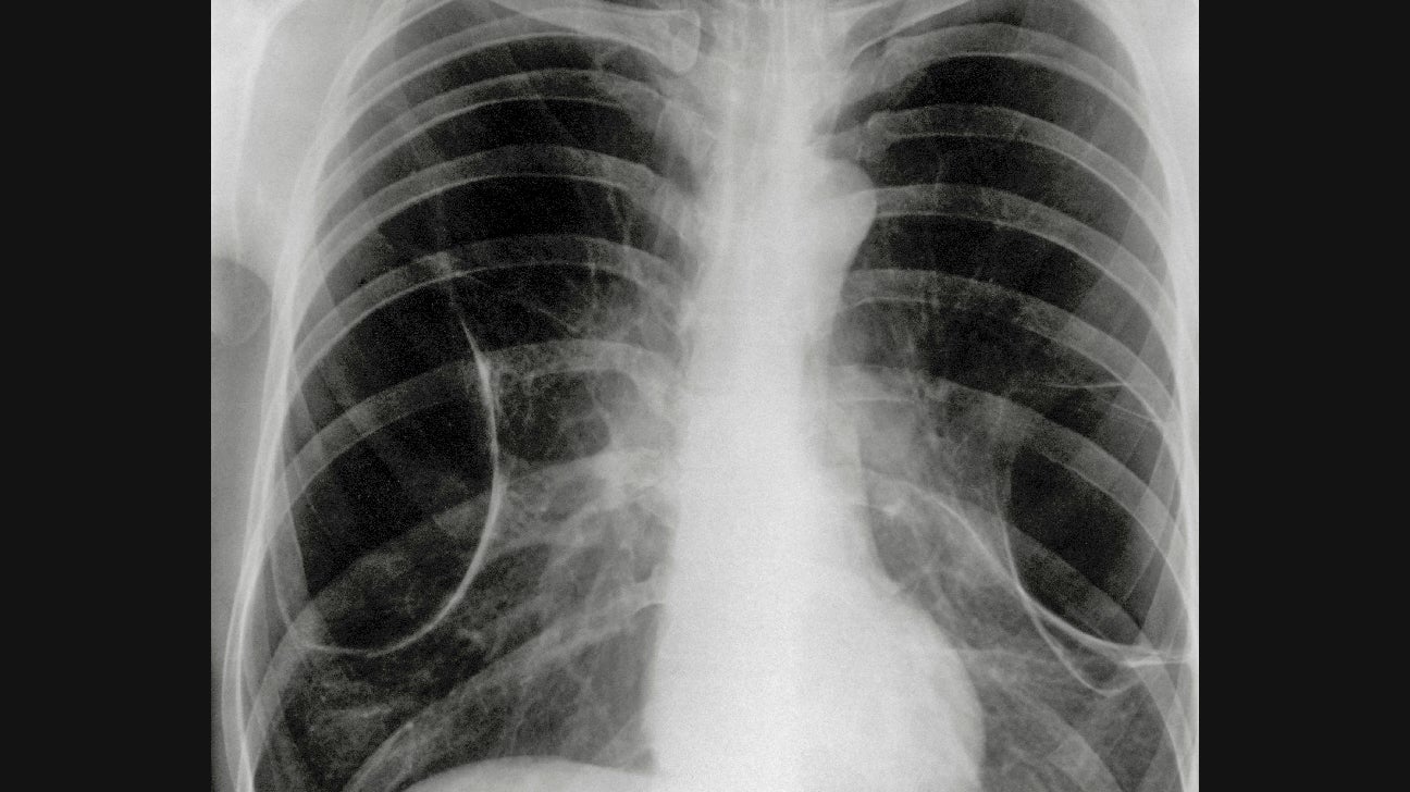 Congenital Emphysema Understanding this Respiratory Condition