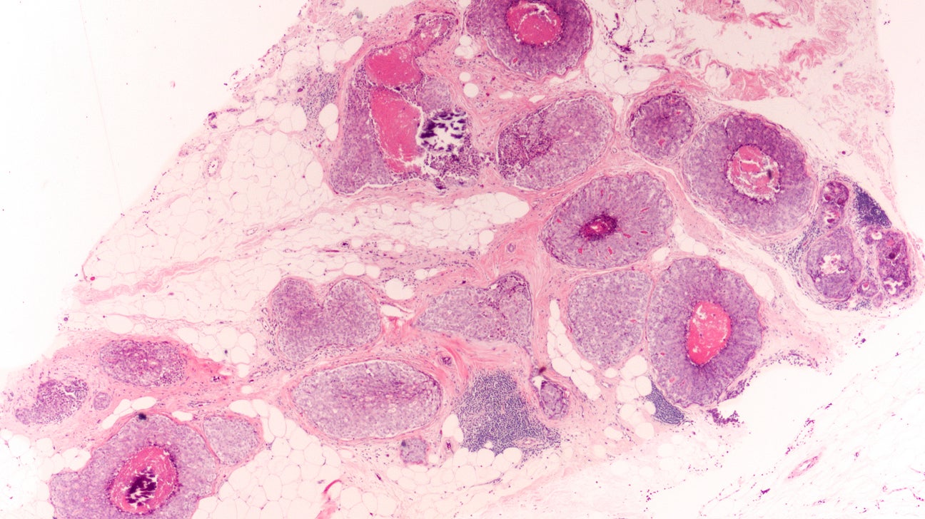 Definition of intraductal breast carcinoma - NCI Dictionary of