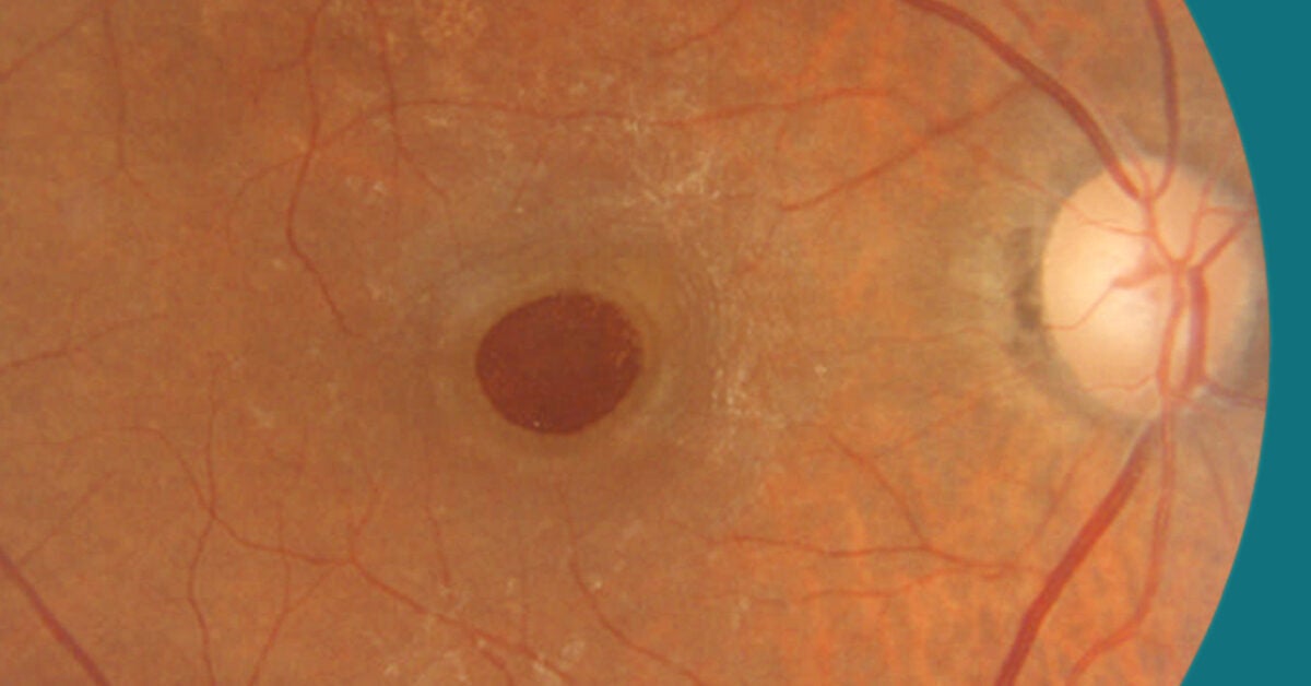 macular hole