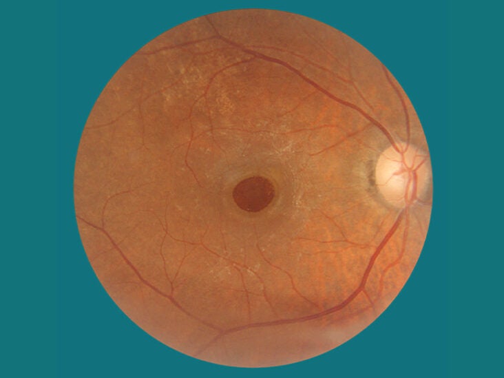 What Is a Macular Hole in the Eye?