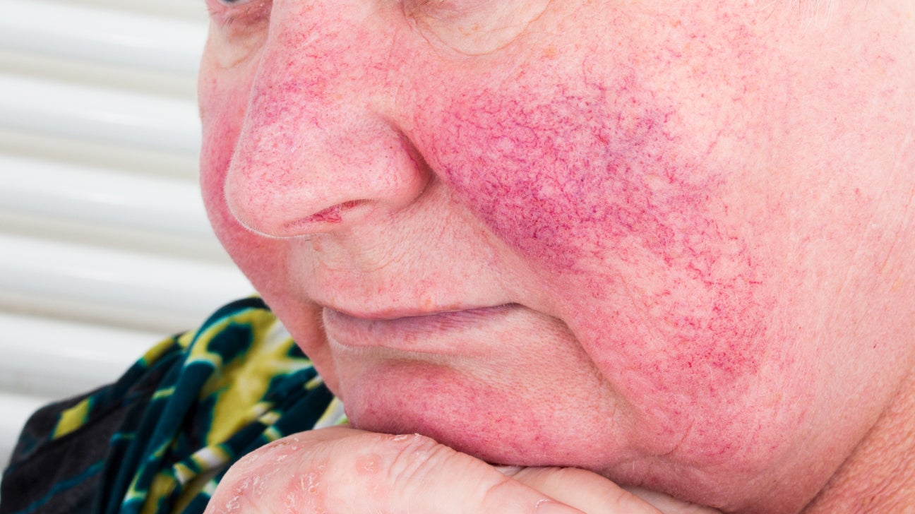 Rosy Cheeks, Rosacea, or Something Else? Tips for Identification
