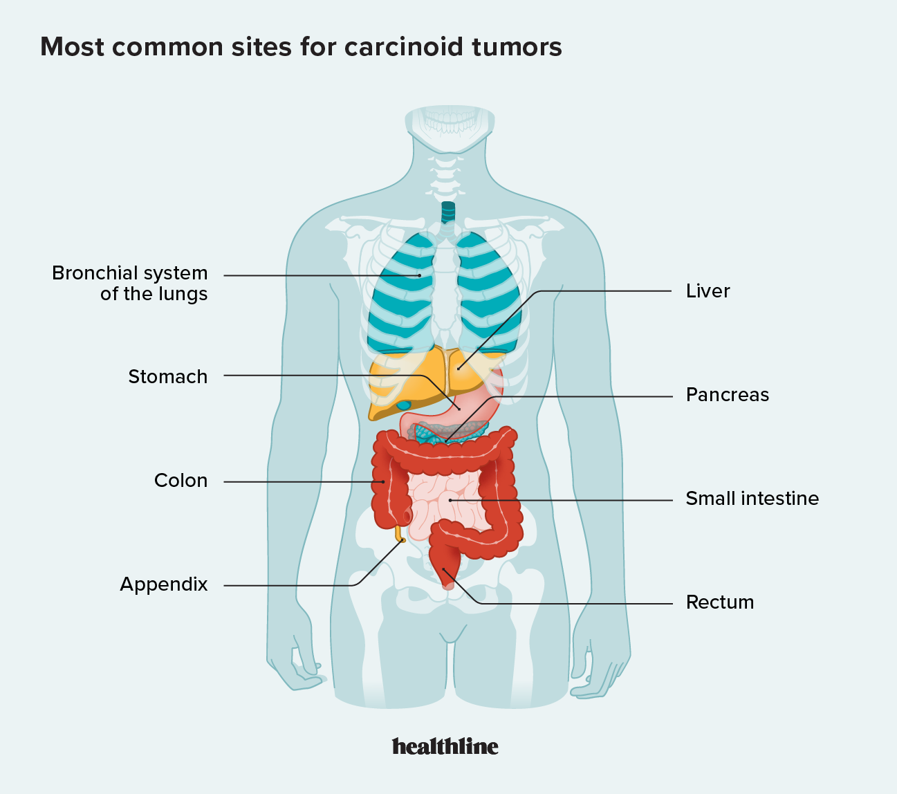 Carcinoid Tumors Symptoms Diagnosis Treatment And Outlook