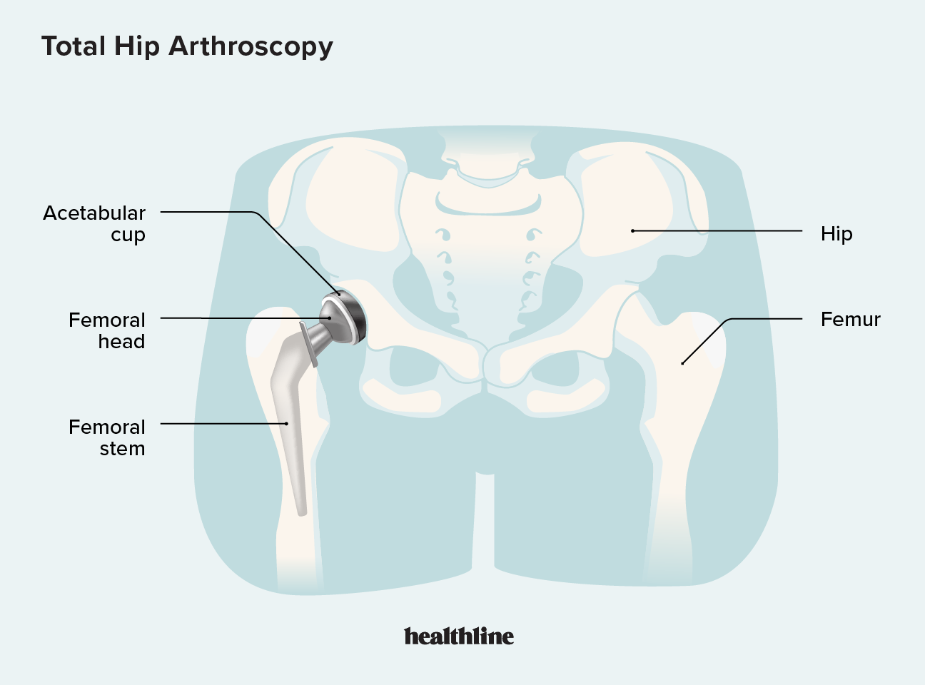 Studies Confirm Benefits of Direct Anterior Approach to Total Hip