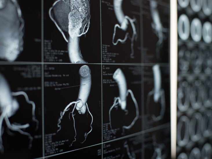 What to Know About a Coronary Calcium Test