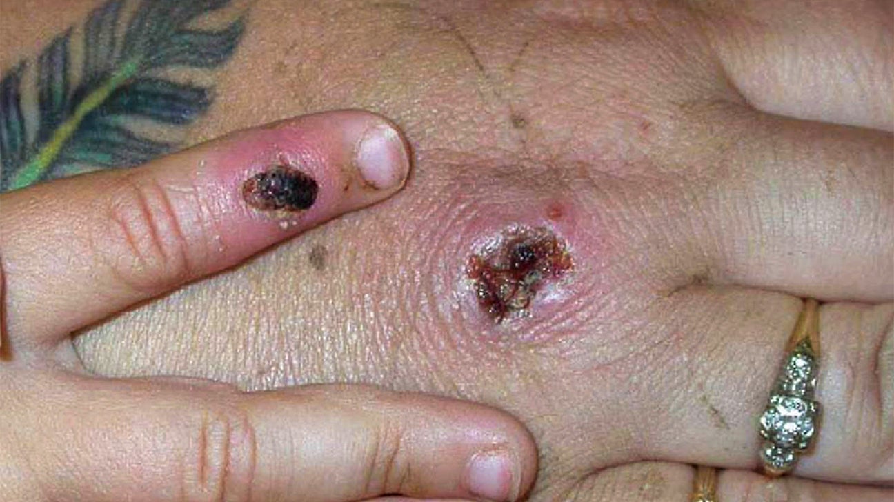 What is monkeypox and its signs and symptoms?