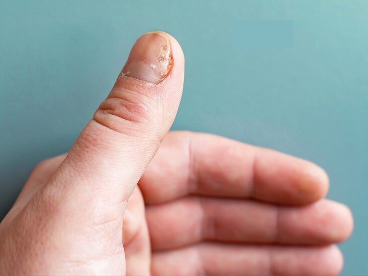 What is the Nail Psoriasis Severity Index?
