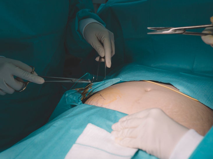 Ileal Conduit Purpose, Procedure, and Care