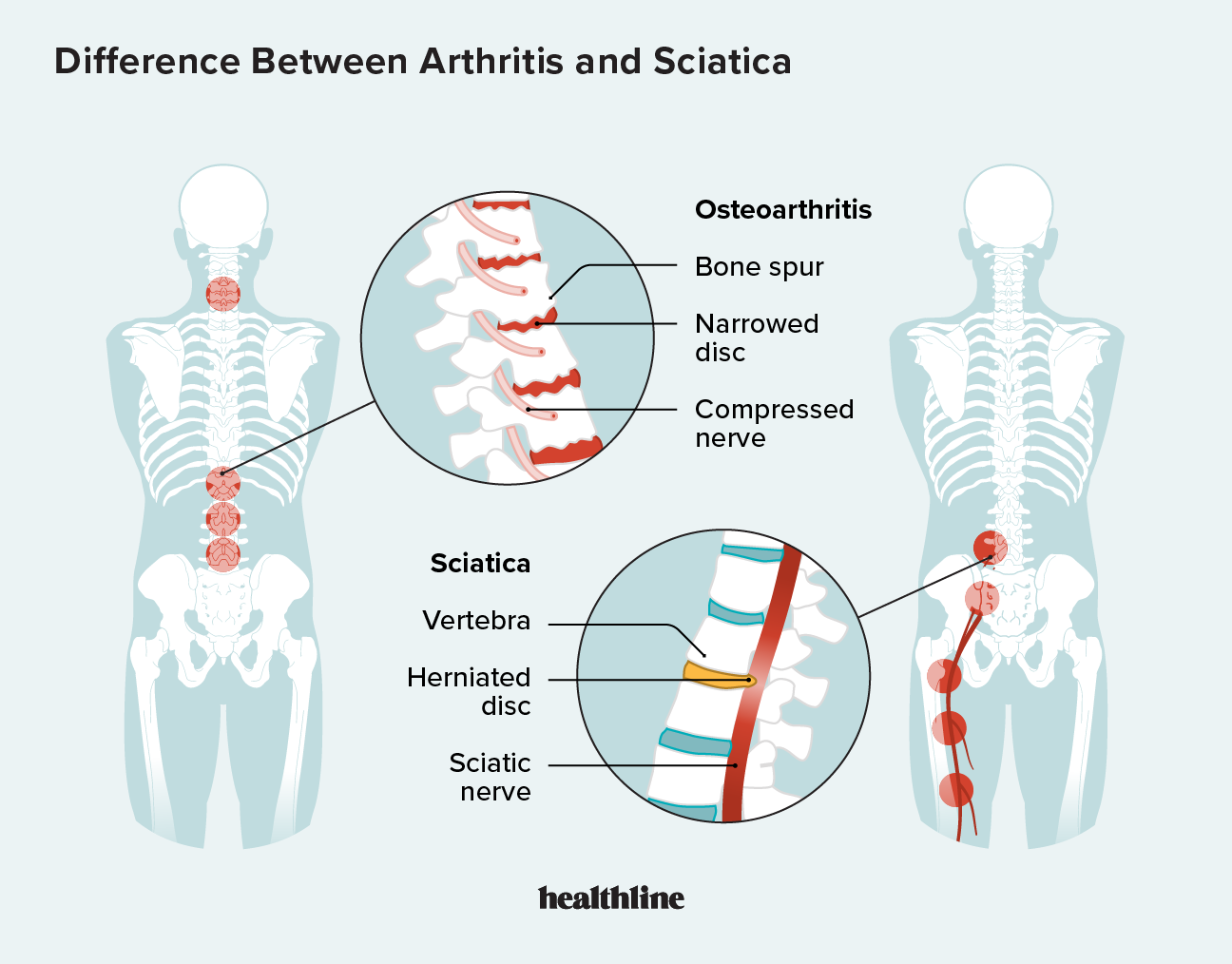 Arthritis and Sciatica: How They Differ, Causes, Symptoms, More