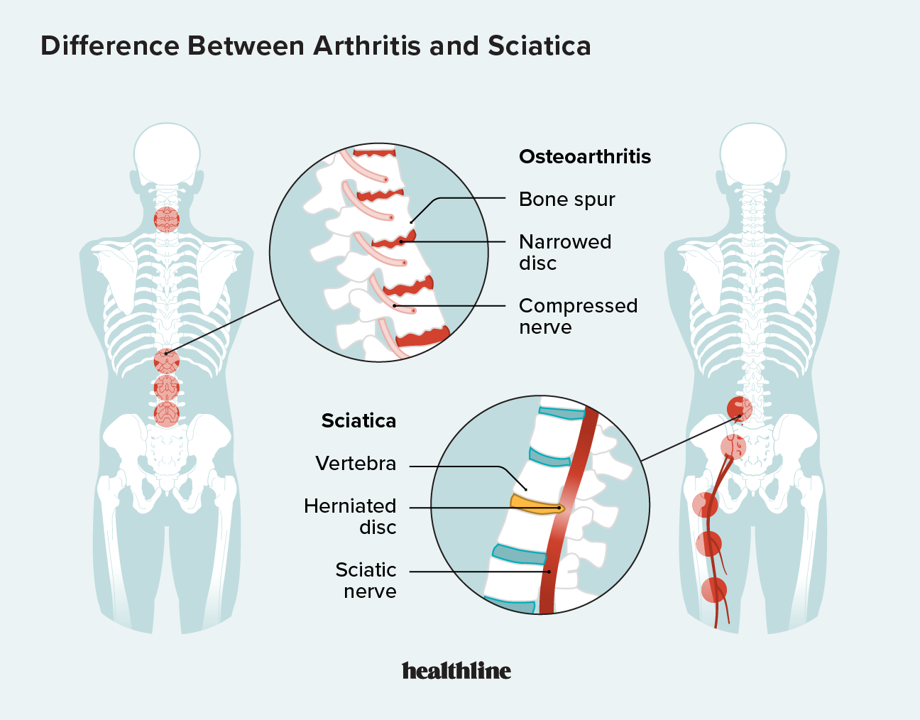 arthritis-and-sciatica-how-they-differ-causes-symptoms-more