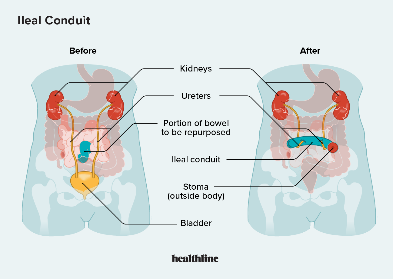 Types Of Urinary Diversion Procedures Ileal Conduit 56 OFF