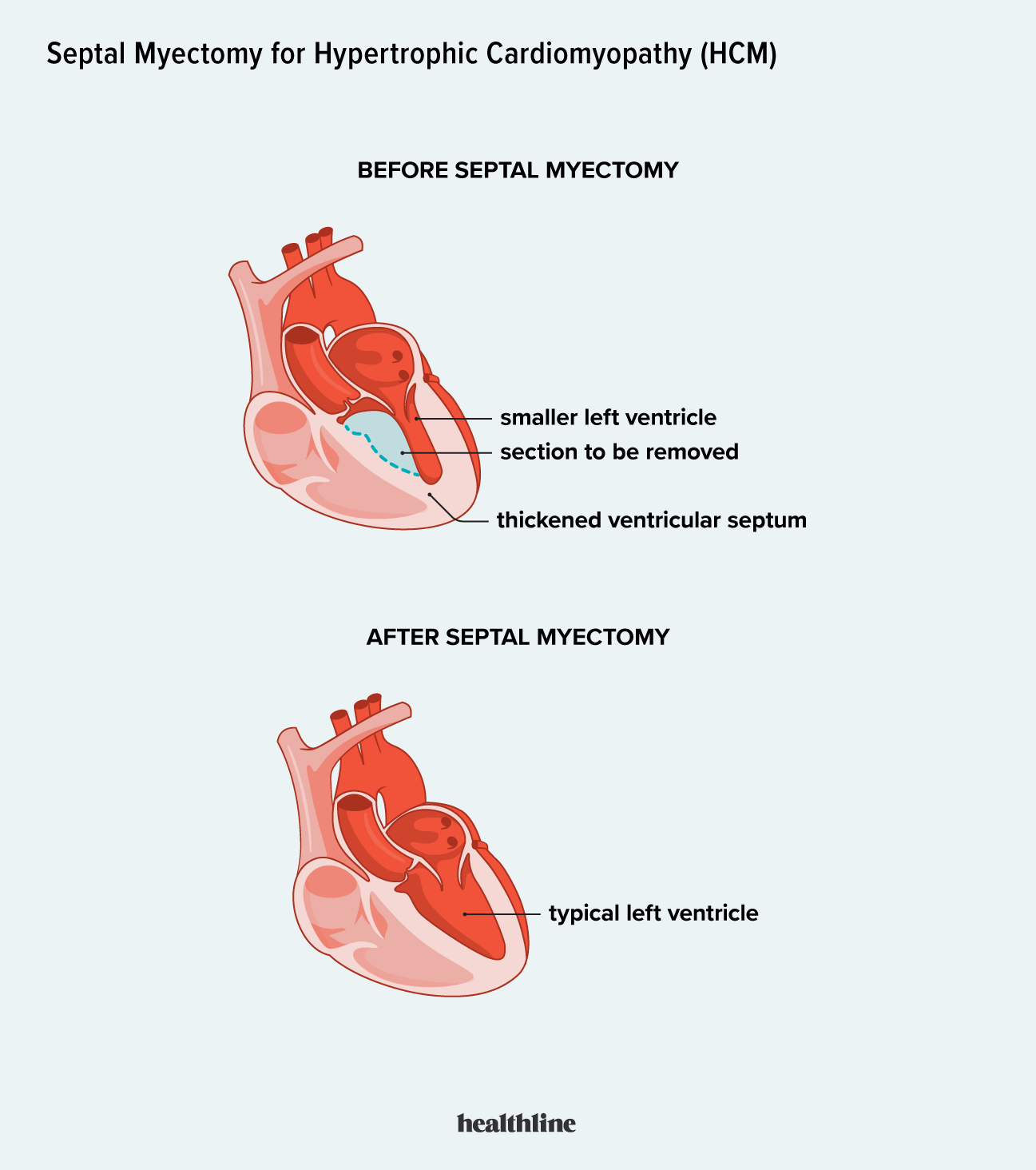 Septal Myectomy Procedure Risks Recovery And Outlook