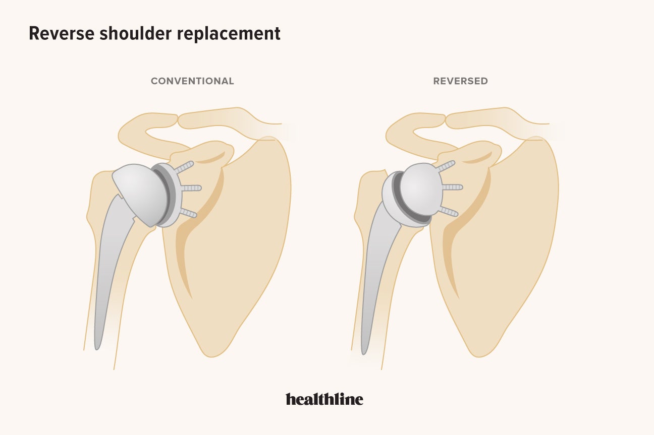 Your Guide to Reverse Shoulder Replacement and Recovery