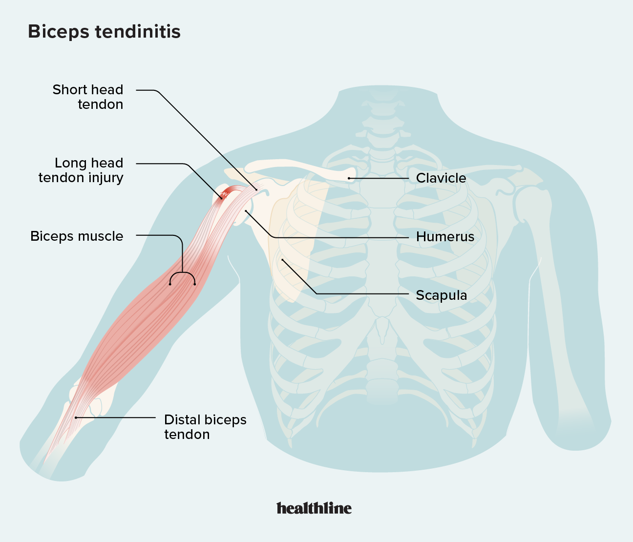 Bicep Tendonitis Causes Symptoms Treatment And More