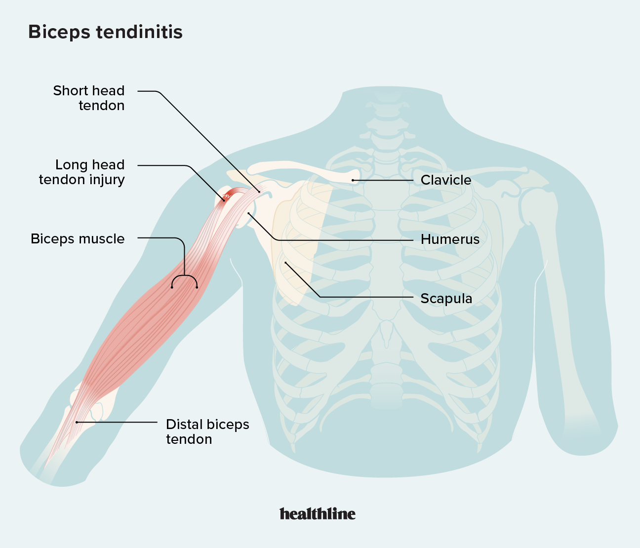 what causes popeye muscle