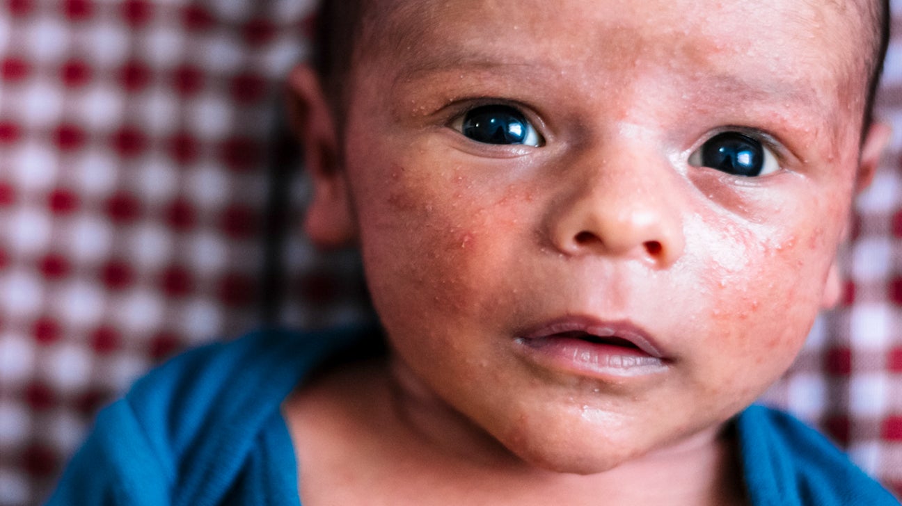 baby allergic reaction rash on face