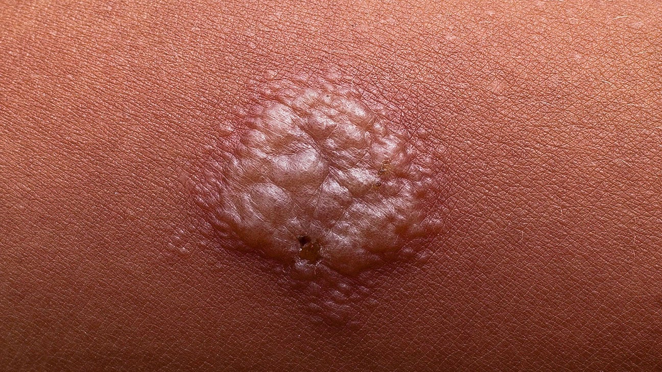 tuberculosis skin symptoms