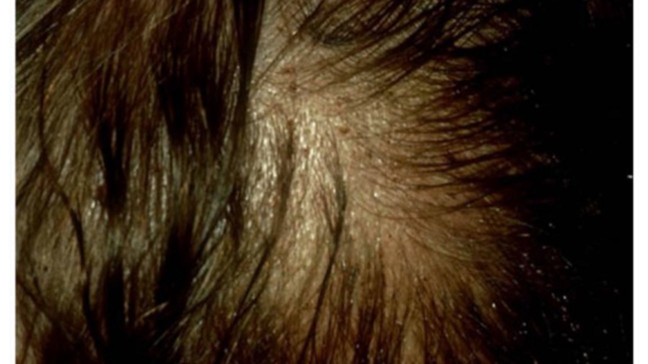 Bites and Stings Pictures, Causes, and Symptoms