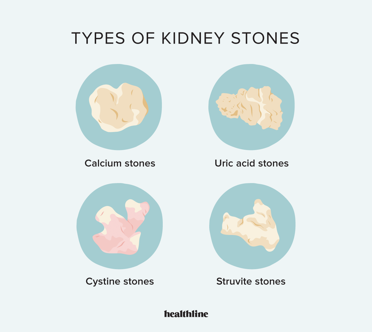 types-of-kidney-stones-chart-comparison-and-treatment